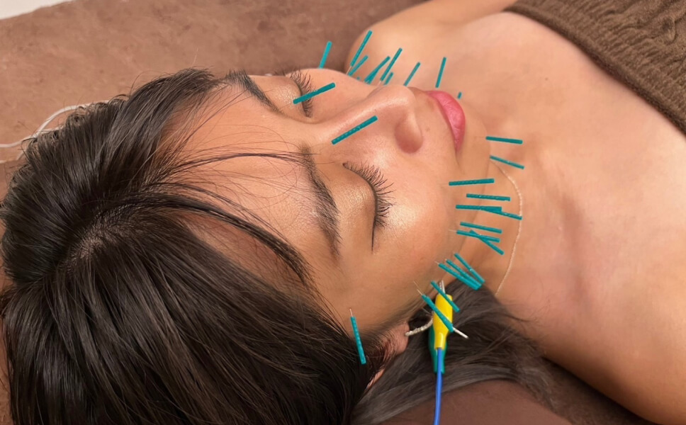美容鍼
